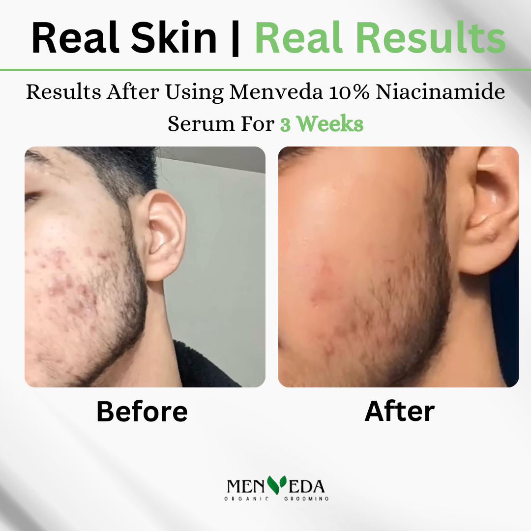 10% Niacinamide Brightening Serum | Gotu Kola , Bakuchiol , Alpha Arbutin & Avocado – 30 ml